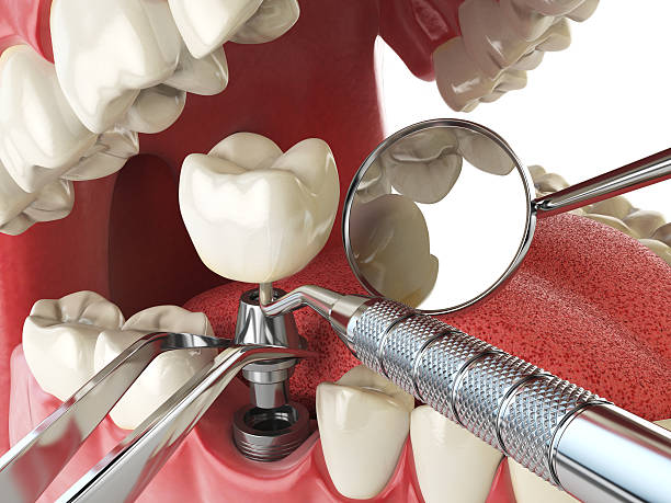 Best Knocked-Out Tooth (Avulsed Tooth) Treatment in Beulah, ND